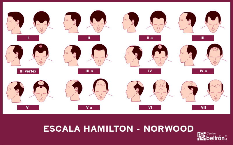 Escala de Hamilton Norwood